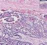 Histopathology Ovary--Serous cystadenocarcinoma