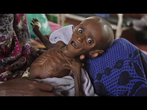 Introduction to malnutrition