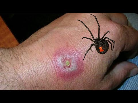 Widow spider bite