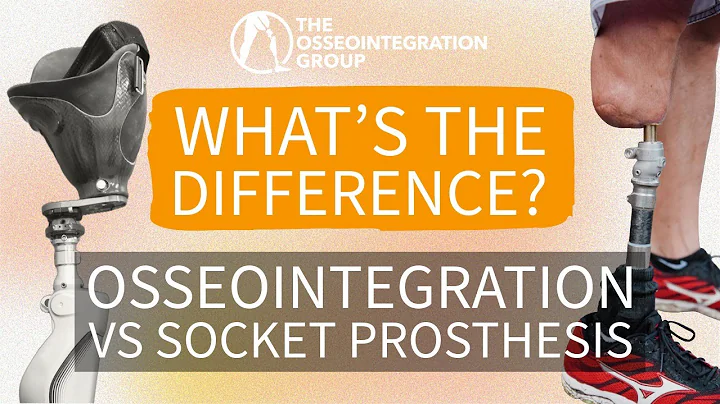 Osseointegration vs Socket Prosthesis: What’s the Difference?