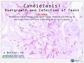Candidiasis: Overgrowth and Infection of Yeast