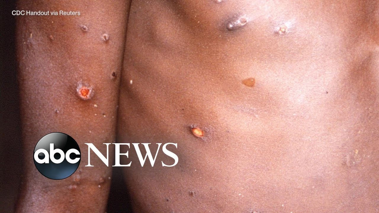 Signs and Symptoms, Mpox, Poxvirus