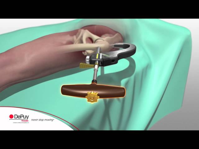 AFFIXUS Hip Fracture Nail System  Zimmer Biomet