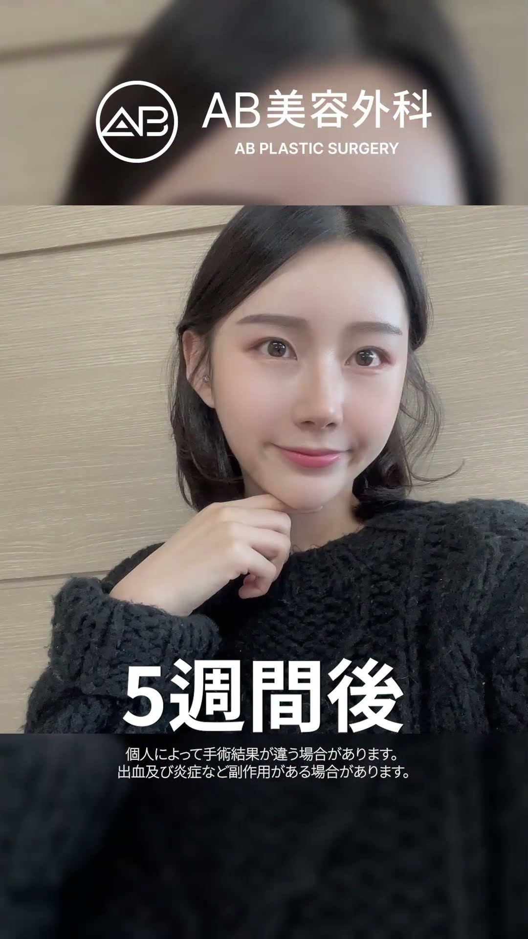劇的な美しさ！美容整形で生まれ変わった彼女 #韓国整形 #美容