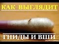 Как выглядят гниды (вши) у человека