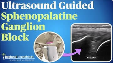 Ultrasound Guided Sphenopalatine Ganglion Block