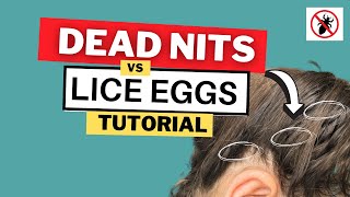 Dead Nits vs Live Lice Eggs Video Tutorial