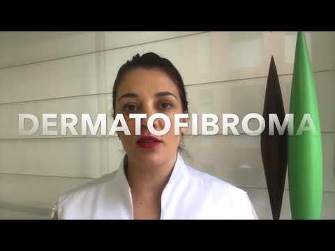 Vídeo: Dermatofibroma - Causas, Tratamento, Remoção