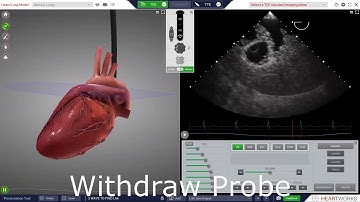 Finding The Left Atrial Appendage with TEE