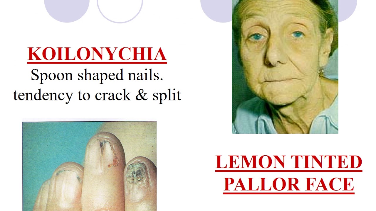 Blood Dyscrasia YouTube
