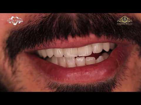 مراحل تصنيع ابتسامة هوليوود بمعمل جي بي اس وبالتعاون مع الطبيب المعتمد الدكتور علي البيطار