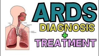 DIAGNOSIS AND TREATMENT OF ACUTE RESPIRATORY DISTRESS SYNDROME (ARDS)
