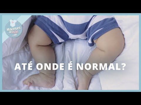 PERNAS TORTAS EM BEBÊS E CRIANÇAS: O QUE VOCÊ PRECISA SABER! | MACETES DE MÃE
