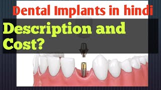 What is Dental Implant /Dental Implant in Hindi/replacement of missing tooth/cost of dental implants