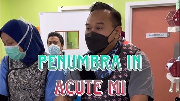 Steps for using Penumbra in Acute Myocardial Infarction