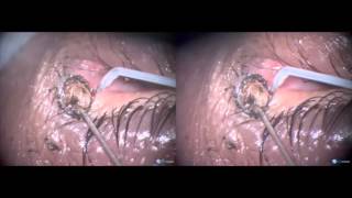 Large Naevus On Punctum And Ciculus- Removal With Fugo Blade