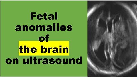 Fetal anomalies of the brain on ultrasound