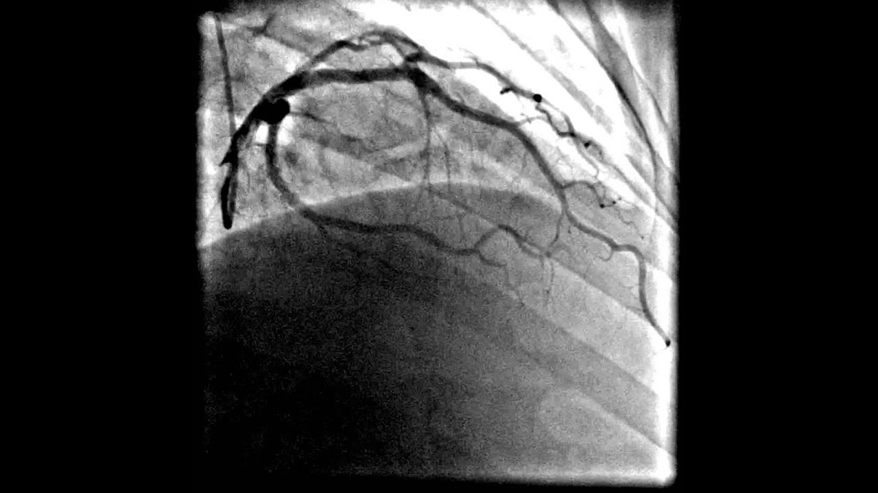 Стентирование видео. Инфаркт на коронарографии. Коронарография сосудов. Ангиография сердца. Коронарография на компьютерной томографии.
