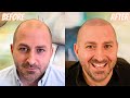 My HAIRLINE IS BACK with Scalp Micropigmentation