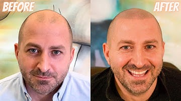 My HAIRLINE IS BACK with Scalp Micropigmentation