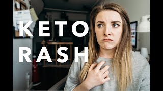 I CURED MY KETO RASH | My Experience With Keto Rash and How I Found Relief