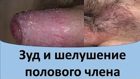 чем лечить творог на члене чем лечить творог на члене