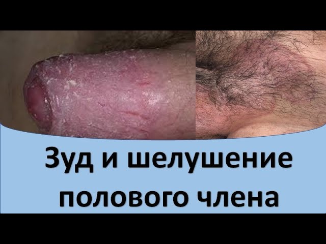 Нужно ли обнажать головку полового члена? - НЦЗД Нужно ли обнажать головку полового члена? - НЦЗД