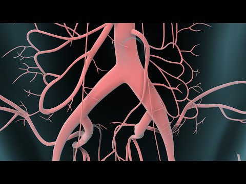 Vídeo: Aneurisma De La Aorta Abdominal: Síntomas, Tratamiento, Cirugía, Rotura