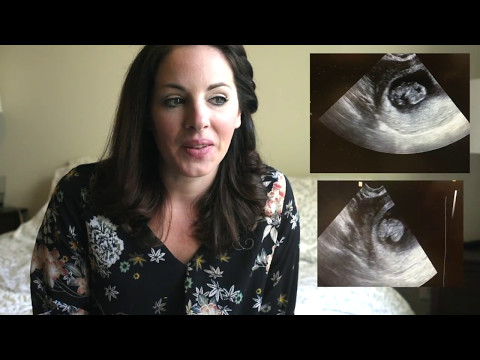 Meckel Gruber Syndrome (My Pregnancy and Loss Story)