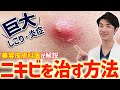 巨大なしこりニキビの原因と治療法！美容皮膚科医が解説します