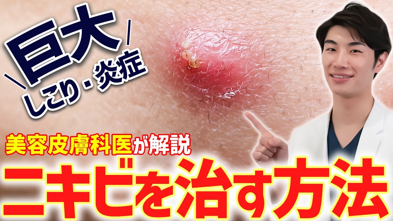 巨大なしこりニキビの原因と治療法！美容皮膚科医が解説します