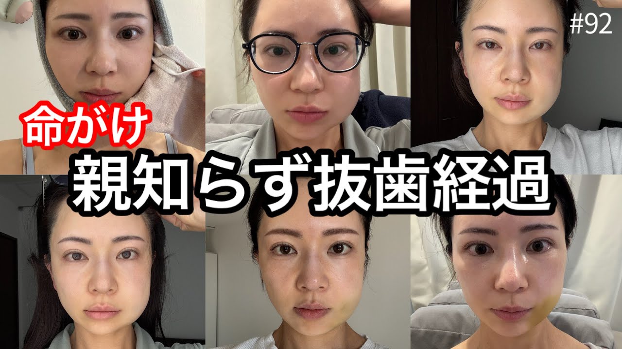 【閲覧注意】親知らず抜歯/当日〜2週間の経過