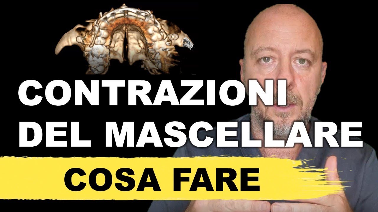 Espansione del palato (mascellare) chirurgica e non: un mio paziente