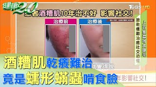 入秋臉乾癢惡化 患者反覆發作10年影響社交! 健康2.0