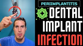 If you wear DENTAL IMPLANTS you should WATCH THIS  Dental Implant INFECTION or PERIIMPLANTITIS