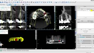 Implant planning with BSP Blue Sky Plan kuwer chani