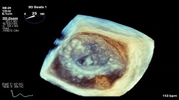 3D TEE -  Bioprosthetic Mitral Valve Thrombosis