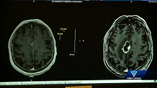 Vaccine trial at Norton Healthcare underway aimed at treating deadliest form of brain cancer