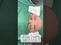 50代女性、眉下リフト＋埋没二重でパッチリ若返り。