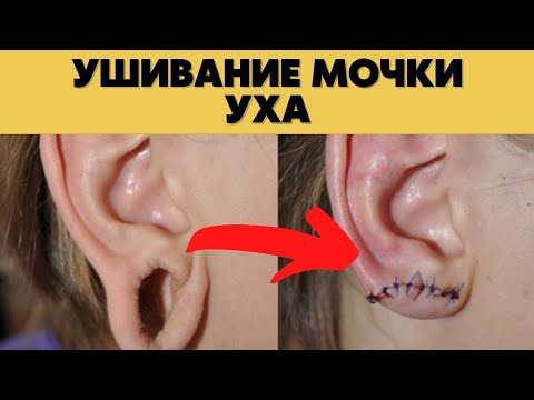 УШИВАНИЕ Мочки УХА