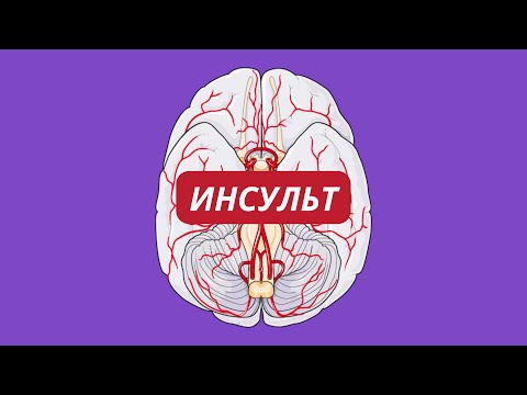 Инсульт, причины, виды, лечение
