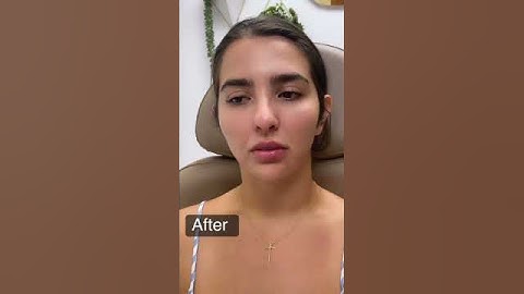 Lip Augmentation - Maylen Cadenas, ARNP #miamiplasticsurgery