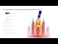 Uso del CMA System en endodoncia