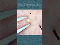 You're worried about acne, aren't you?