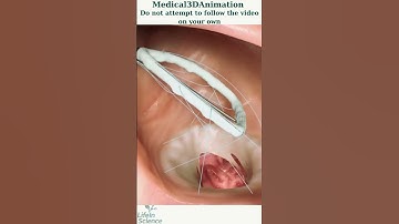 Heart surgery - Realistic 3D Visualization (Watch Only, Don’t Try) Medical 3D Animation #3