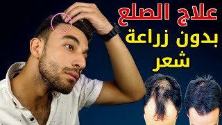 علاج الصلع في اسرع وقت - شعرك هايرجع طبيعي تاني Baldness cure الحريت