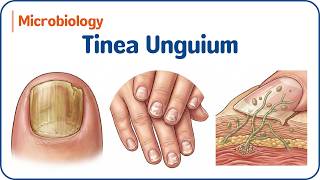19. Tinea Unguium 💅🍄 | Onychomycosis: Types, Diagnosis & Treatment for USMLE & NEET-PG