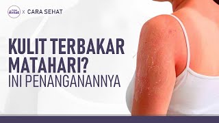 Cara Efektif Mengatasi Sunburn kulit Terbakar Matahari  Hidup Sehat Tvone