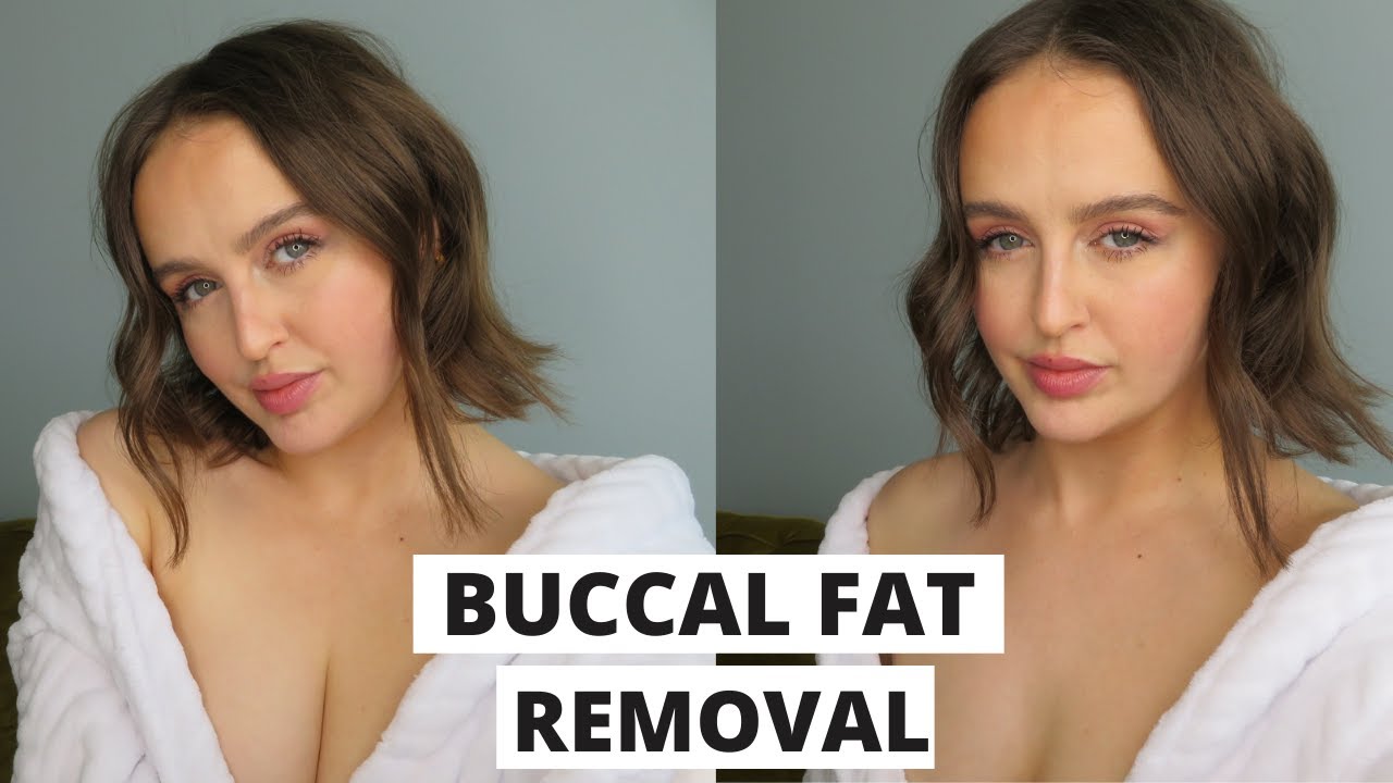 Getting Buccal Fat Removal | Consultation - YouTube