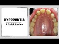 Hypodontia | Oligodontia | Missing Teeth